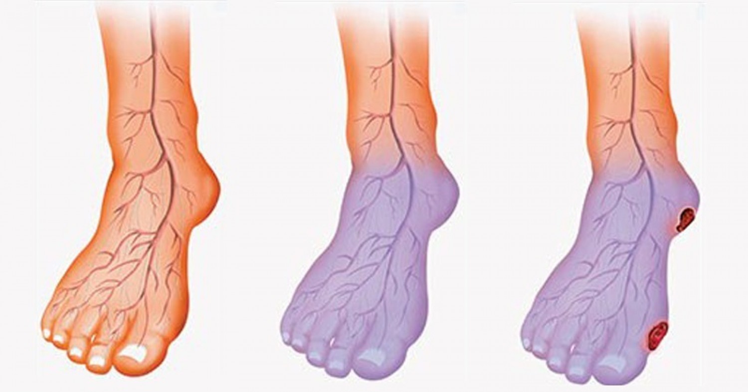 Почему нога фиолетовая. Облитерирующий атеросклероз вен нижних конечностей. Атеросклероз нижних конечностей гангрена. Диабетическая ангиопатия ног. Облитерирующий тромбофлебит.